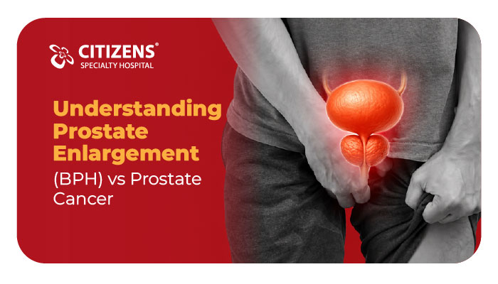 Understanding Prostate Enlargement (BPH) vs Prostate Cancer