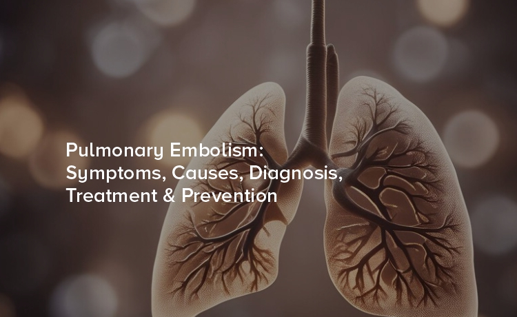 Pulmonary Embolism: Symptoms, Causes, Diagnosis, Treatment & Prevention