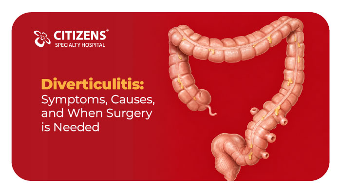 Diverticulitis: Symptoms, Causes, and When Surgery Is Needed