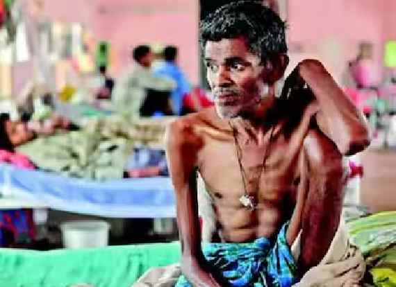 Malnutrition, Stigma, Drug-Resistant TB : Major Challenges For Tuberculosis Control In India